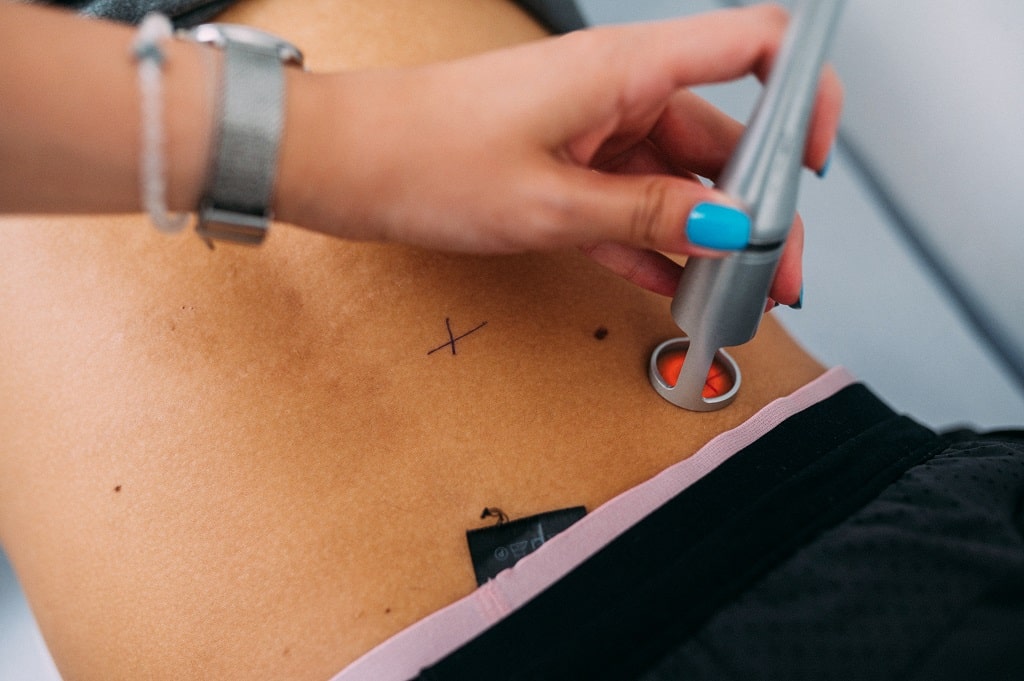 HILT laser kod bola u ledjima