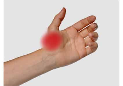 Bol u palcu rizartroza