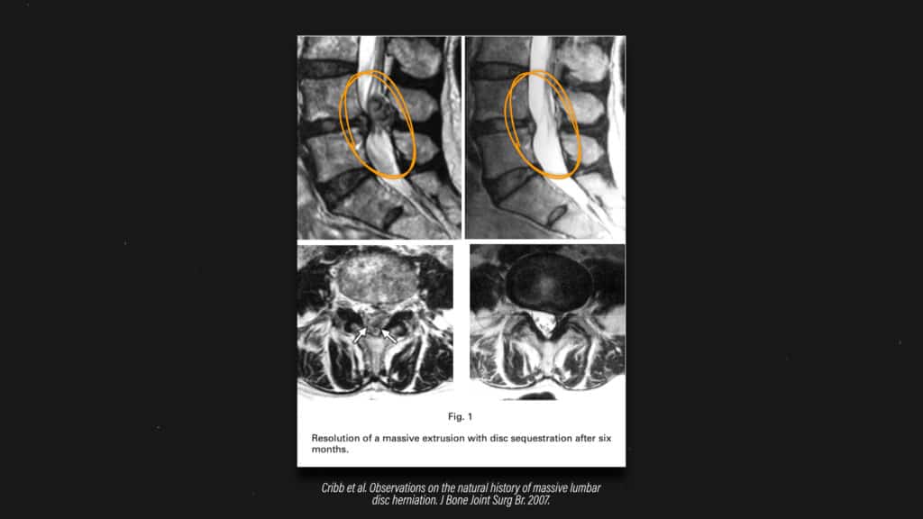 diskus hernija lečenje