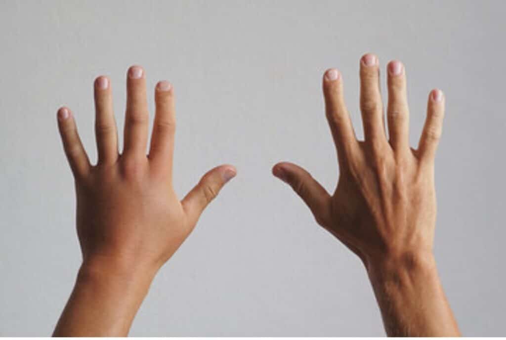 otok šake kod sudekovog sindroma