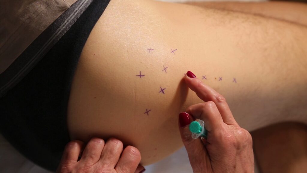 trohanterični burzitis